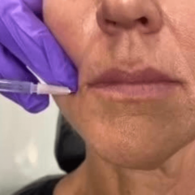 DAO (downward mouth corners) at Accent Med Spa