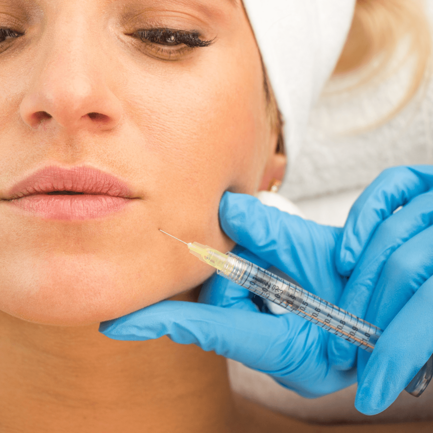 Marionette Line Filler ("Puppet Lines") at Accent Med Spa