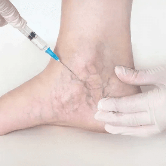 Sclerotherapy (Leg Vein Treatment)