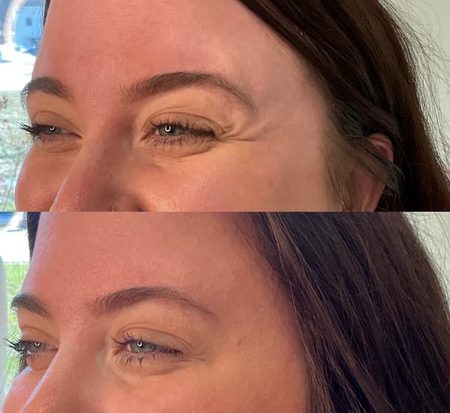 Miley B. - Crow's Feet results