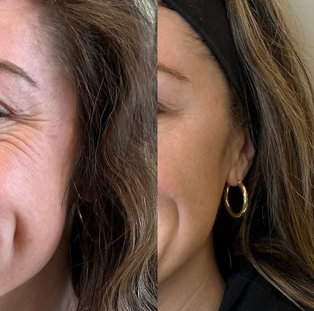Kim C. - Crow's Feet results