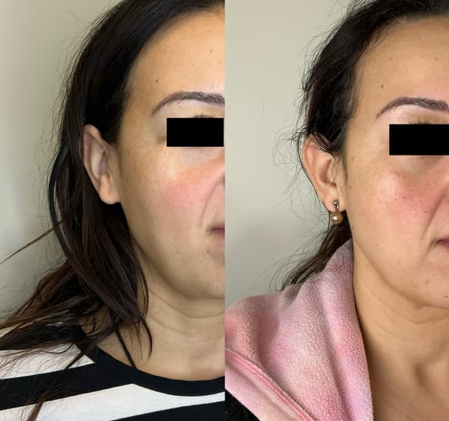 Sadie Z. - Emface Eyes results
