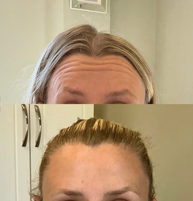 Tara B. - Forehead results