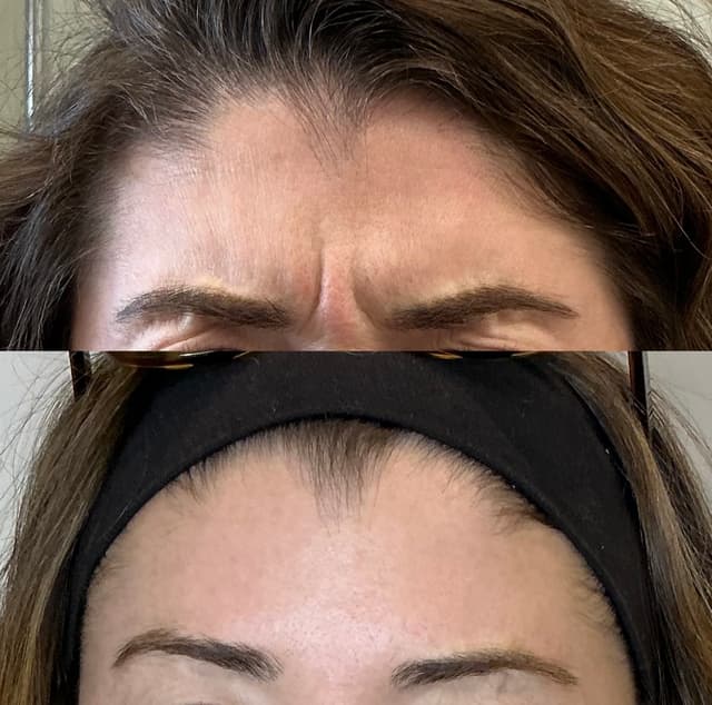Mia W. - Forehead results