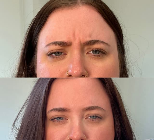 Sara S. - Glabella results