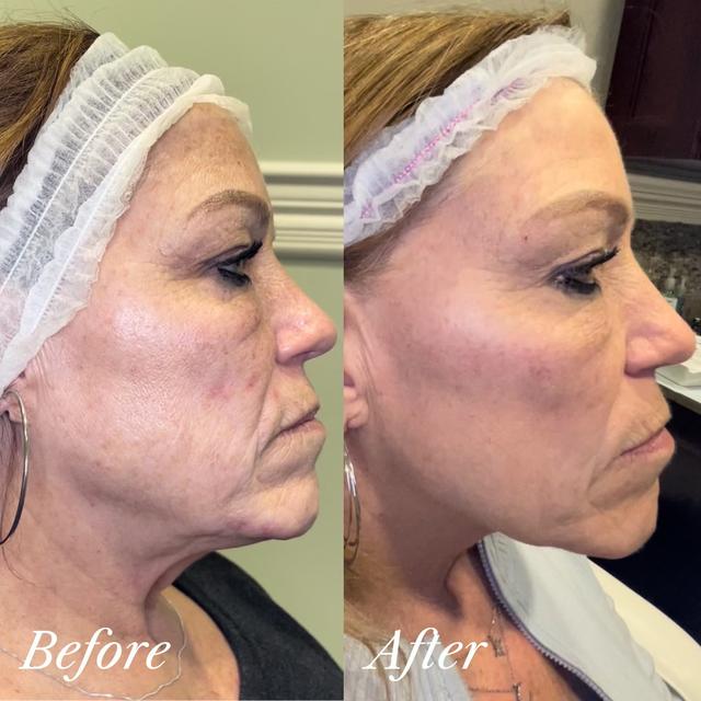 Melanie K. - EmFace results