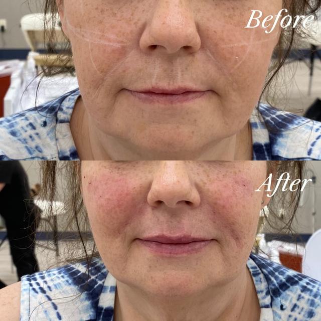Ashley F. - Exion RF Microneedling results