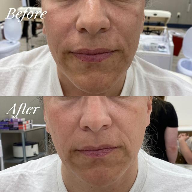 Hannah J. - EmFace results