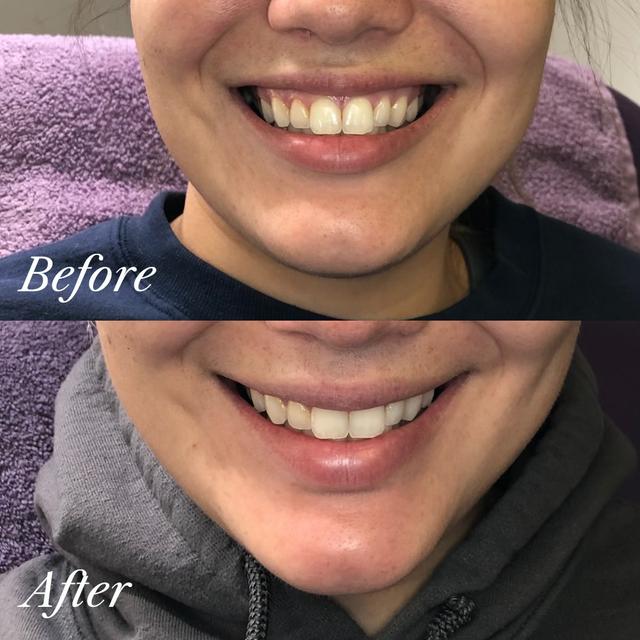 Nicole A. - Exion RF Microneedling results