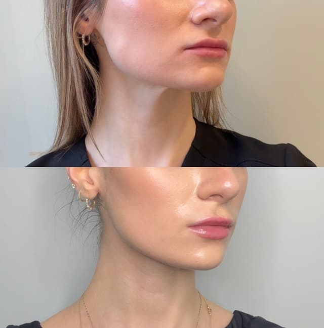 Mia W. - TMJ/Teeth Grinding Treatment with Neurotoxin results