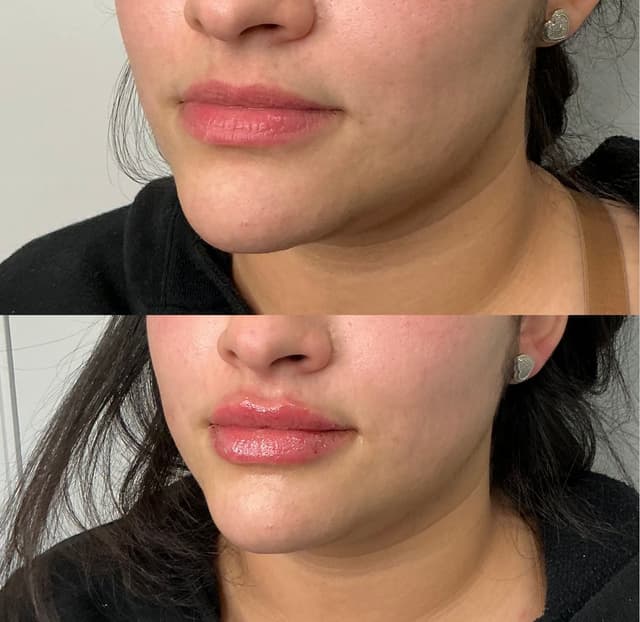 Julia M. - Lip Filler results