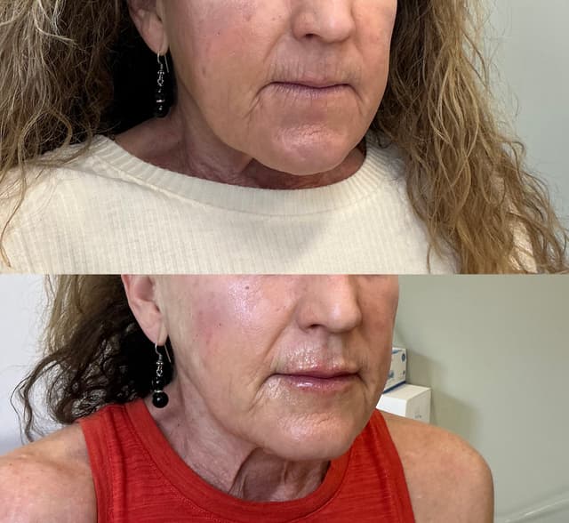 Rosalie C. - Lip Filler results