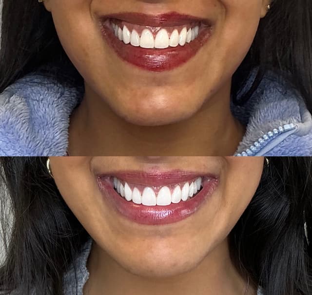 Olivia G. - Lip Filler results