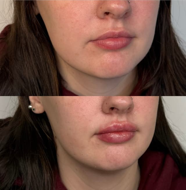 Krissy W. - Lip Filler results