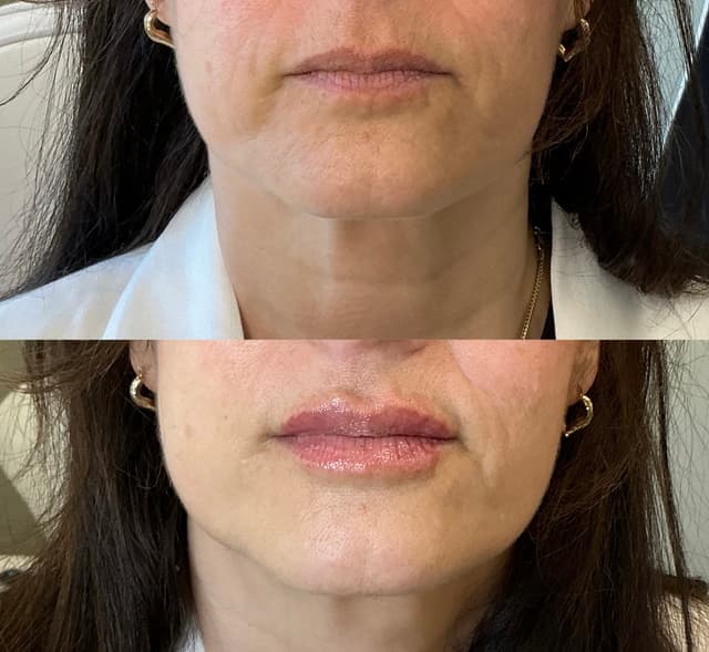 Mary K. - Lip Filler results