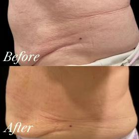 Sadie Z. - EmSculpt NEO results