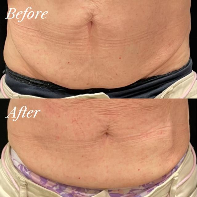 Janet A. - EmSculpt NEO results