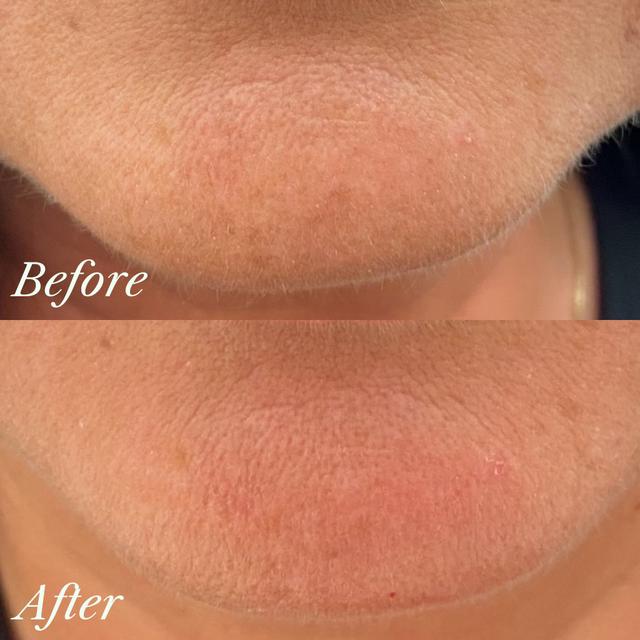 Kelly E. - EmSculpt NEO results