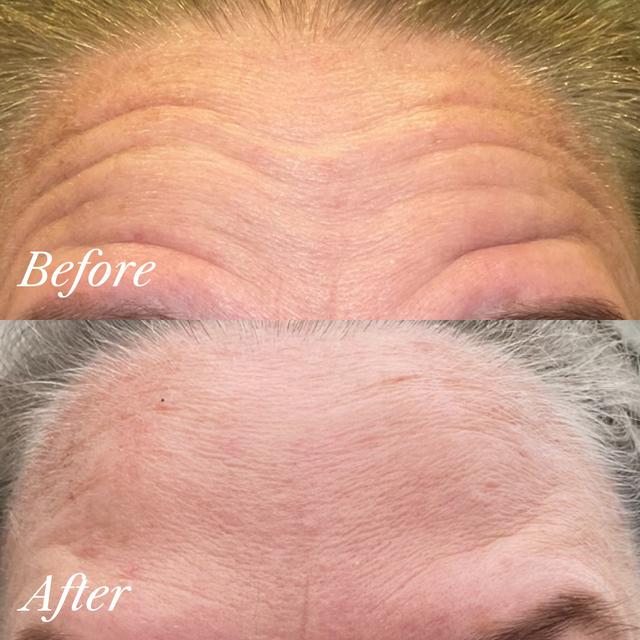 Mia W. - TMJ/Teeth Grinding Treatment with Neurotoxin results