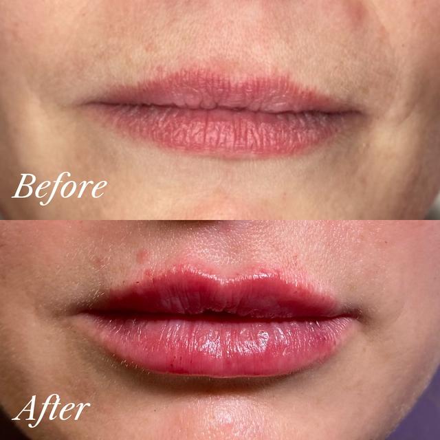 Rosalie C. - Nasolabial Folds (Smile Lines (NLF)) results