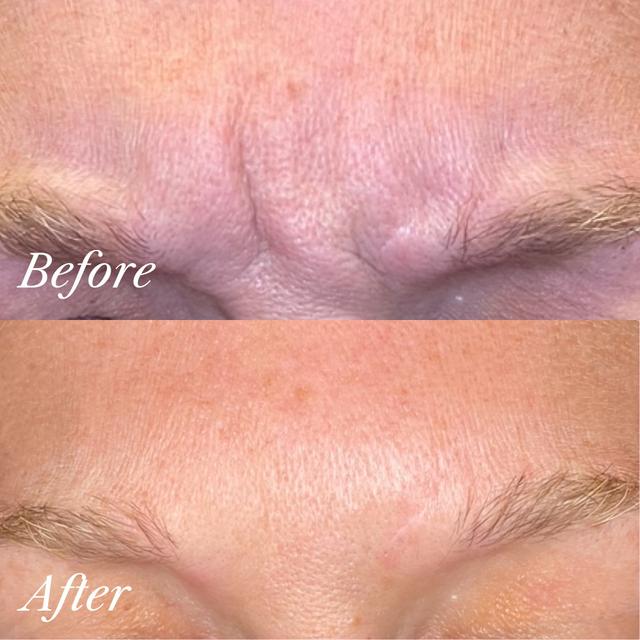 Olivia G. - Nasolabial Folds (Smile Lines (NLF)) results