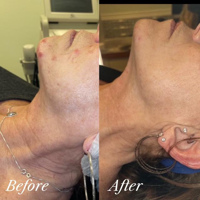 Megan H. - Chin Filler results