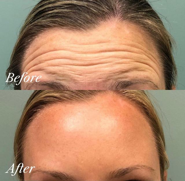 Tara B. - TMJ/Teeth Grinding Treatment with Neurotoxin results